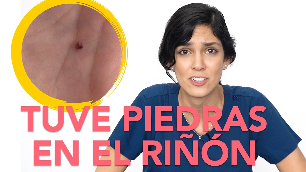 Mi experiencia con piedras en el riñón (CÁLCULOS RENALES) | Dra. Jackie - Salud en Corto