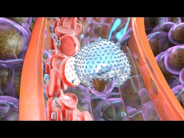 Что Такое Инвазия В Онкологии Почки