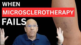 Why Some Spider Veins Resist Microsclerotherapy: The Role of Vessel Size and When to Change Approach