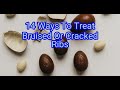 14 Ways To Treat Bruised Or Cracked Ribs Life Hacks