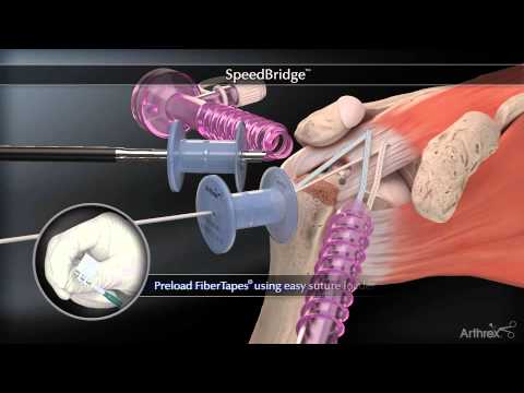 Tratamentul trocharteritei articulației șoldului