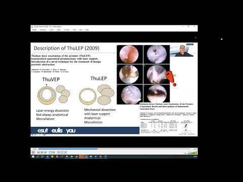 UROwebinar: Laser Endoscopic Anatomic Enucleation of Prostate (AEEP)