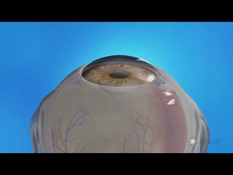 Femtosecond Laser-Assisted Cataract Surgery