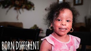Download lagu The Little Girl Whose Skin Grows Too Fast | BORN DIFFERENT mp3 Download lagu The Little Girl Whose Skin Grows Too Fast | BORN DIFFERENT mp3