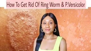 HOW TO GET RID OF RING WORM.ringworm cure,pityriasis versicolor cure,how to cure ringworm.