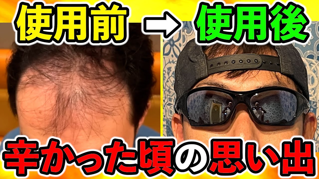 辛かった会社でのエピソードから始まったAGA投薬治療２年目の今、正直な気持ちをお話します。（薄毛、ハゲ、発毛、育毛）