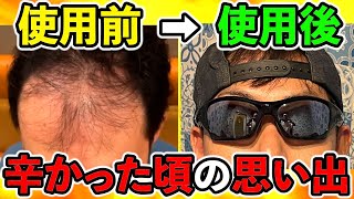 辛かった会社でのエピソードから始まったAGA投薬治療２年目の今、正直な気持ちをお話します。（薄毛、ハゲ、発毛、育毛）