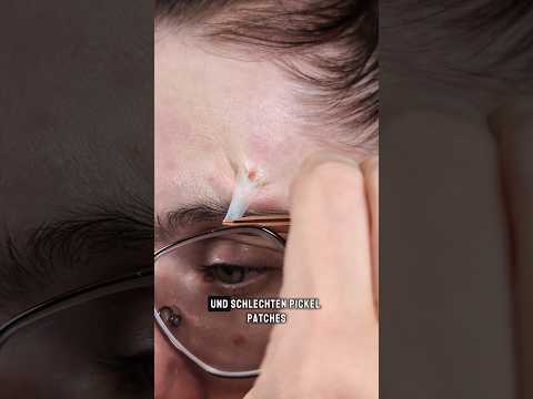 This is the good time... these are the good pimple patches 🫶🏼#pimple #blackhead #pimplepatch #acne