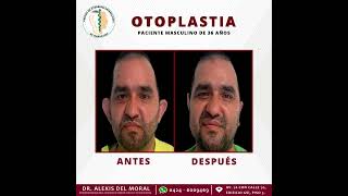 Otoplastia ORL