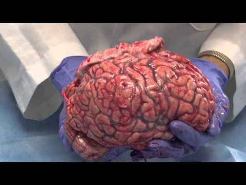 Autopsie du cerveau non fixé