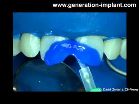 comment reparer appareil dentaire casse