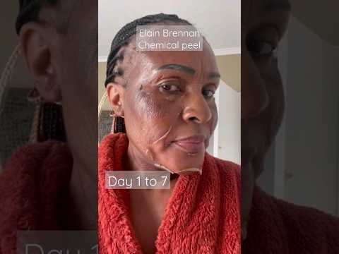 Chemical peel, day 1 to 7 , skin Resurfacing #foryou #shorts #shortvideo