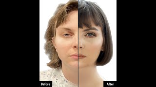 Brow Bone Reduction Hairline Lowering Facial Feminization Surgery