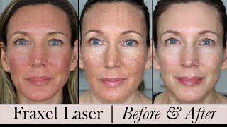 Fraxel Face Laser ~ Before & After! 3 Month Update