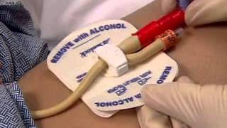Product video: Bard StatLock Foley Stabilization Device - Catheter Securement