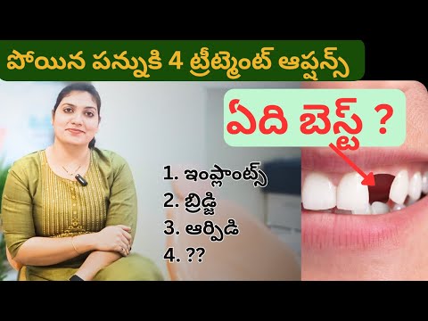 Best Tooth Replacements Options for Missing Teeth - Dr. Swetha