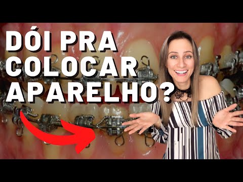 Dói pra colocar aparelho?😰 #aparelhoortodôntico #dravanessagualda #aparelho #dentista #brasil