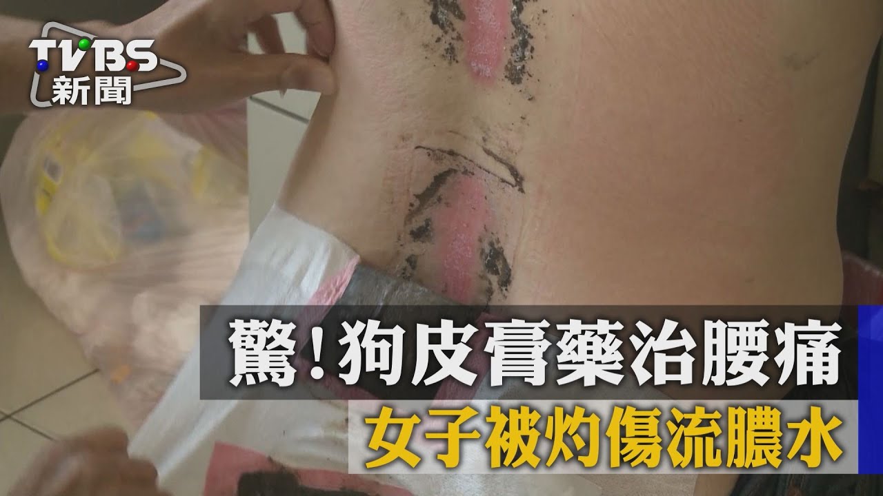 驚!狗皮膏藥治腰痛 女子被灼傷流膿水