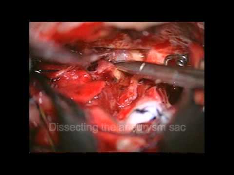 ACommA: Clipping of a ruptured ACommA aneurysm (subfrontal interhemispheric approach)