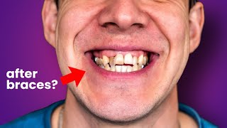 Why are your teeth Still Crooked after braces…the truth