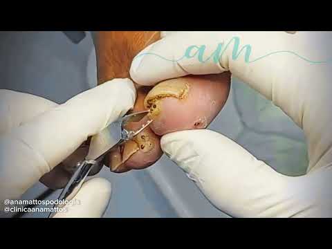 Patient with many insects standing (Tunga penetrans)