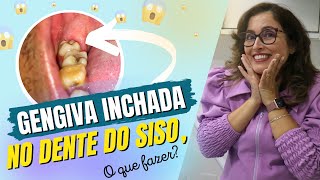 Gengiva inchada no dente do Siso, o  que fazer Adornare Odontologia em Santos