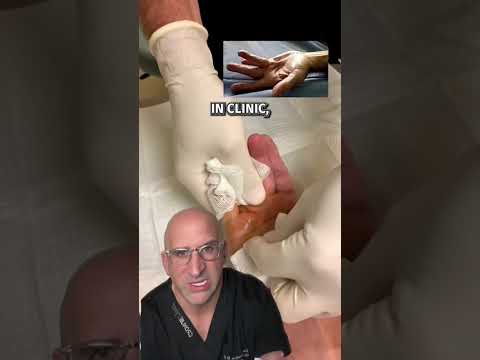 Listen for the POP 🔊DUPUYTREN’S Contracture Quick Fix #shorts
