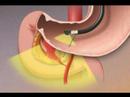 Treating GI Bleed-Mayo Clinic