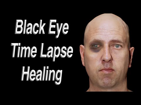 Black Eye Facial Trauma Time Lapse Healing