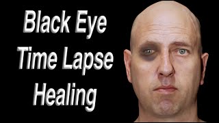 Download lagu Black Eye Facial Trauma Time Lapse Healing mp3