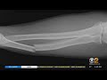 New Bandage Uses Stem Cells To Heal Broken Bones Faster