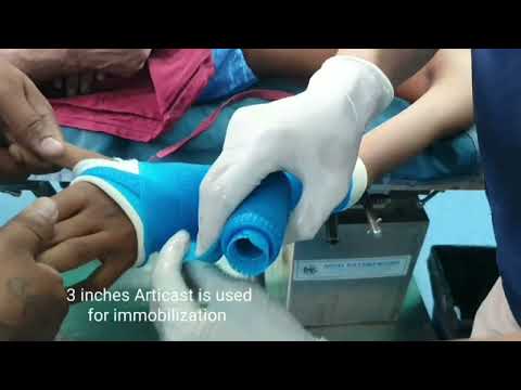 Wrist fractures in kids | Epiphyseal injury | Closed reduction fractures Fiberglass | Adamya H Vid