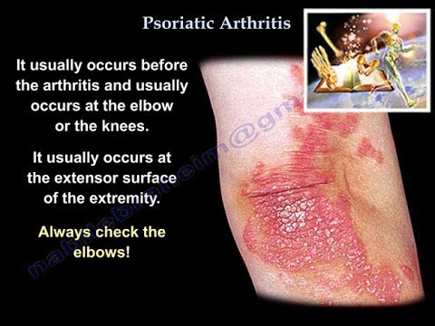 Psoriasis ayurvedic treatment in tamil