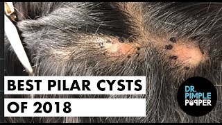 Best of Dr Pimple Popper 2018 pilar cysts
