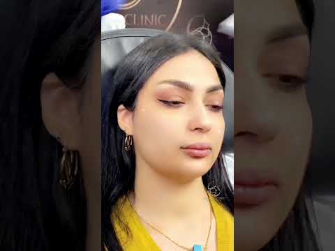 Filler Cheek Augmentation 🤩😉💉                            #short #cheekfiller #shorts #cheeks