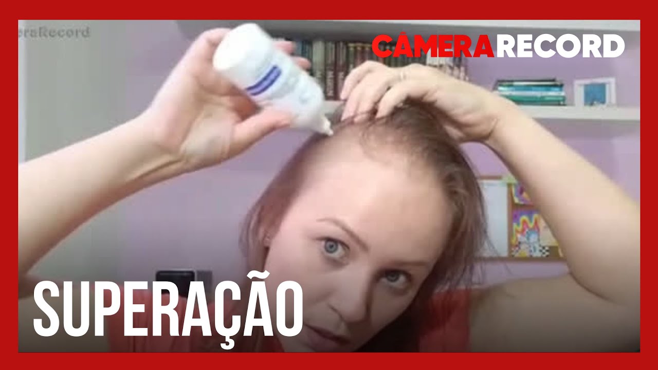 Mulher conhece o tratamento correto para alopecia depois de vencer o câncer