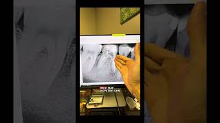 Don’t do it if you don’t know how to do it properly. #dentists #rootcanaltherapy 