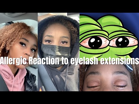 YouTube video about: How do you treat an allergic reaction to eyelash extensions?
