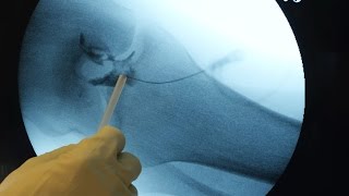 TheRegenexxACLStemCellProcedure:In-DepthwithDr.JohnSchultz