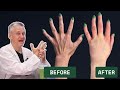 Fat Transfer To Hands Podcast How It S Done
