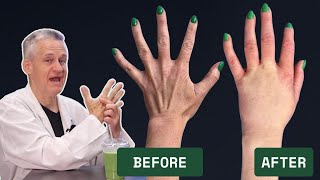 Fat Transfer to Hands (Podcast) - How It's Done