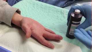 felon drainage - abscess of the pulp of a finger