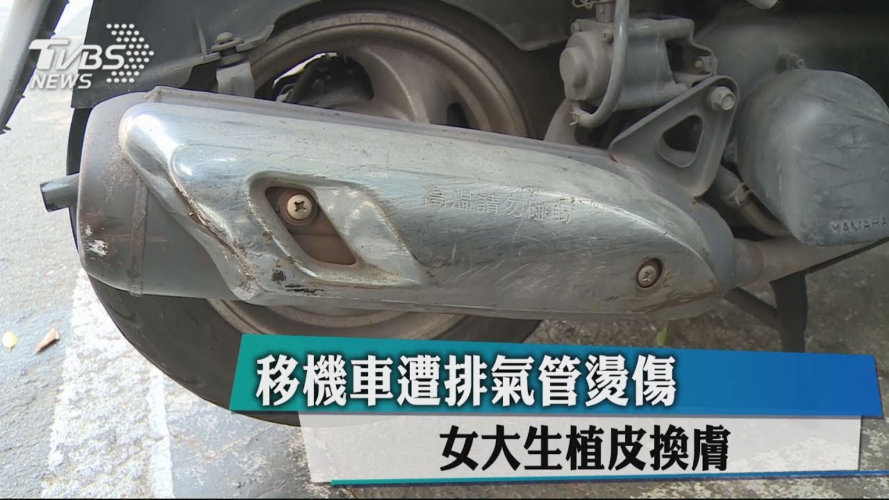 移機車遭排氣管燙傷 女大生植皮換膚