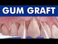 Gum graft - Coronally advanced flap - Receding gums treatment ©