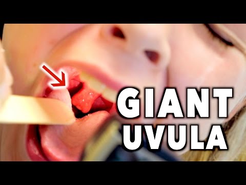 GIANT UVULA! (Bad Throat Infection) | Dr. Paul