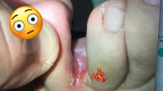 HONGOS PIE DE ATLETA / REMEDIO %100 EFECTIVO TRATAMIENTO