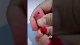 Download lagu AMBIL DARAH SENDIRI Pemeriksaan DARAH KAPILER #laboratory #sakit #darah #sampling #kesehatan #shorts mp3