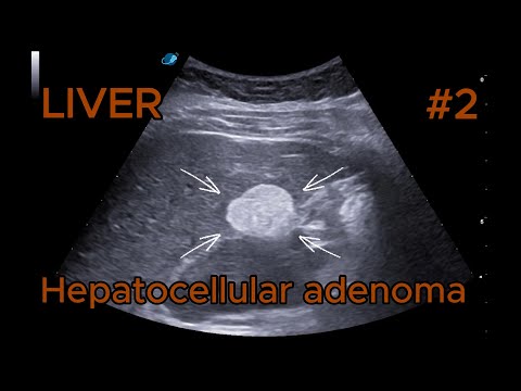 HNF1α-mutated hepatocellular adenoma - Hyperechoic video preview