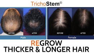 Hair Loss Treatment for Thicker and Longer Hair Regrowth