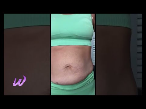 Skin & stretch marks after baby. Here is how it looks after losing 35 lbs and healing ab separation